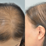 O que é Alopecia