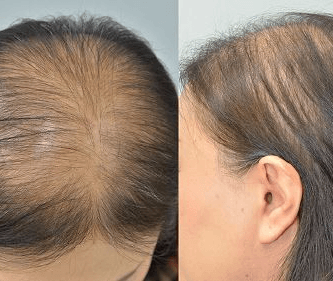 O que é Alopecia