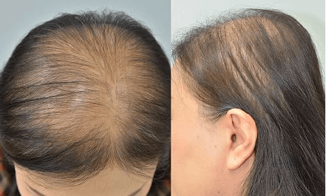 O que é Alopecia
