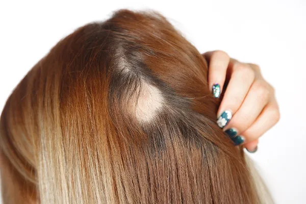 O que é Alopecia: Causas e como tratar ? 3 alopecia em ruiva