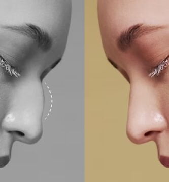 Passo a passo da recuperação de uma rinoplastia: o que esperar 2 rinoplastia